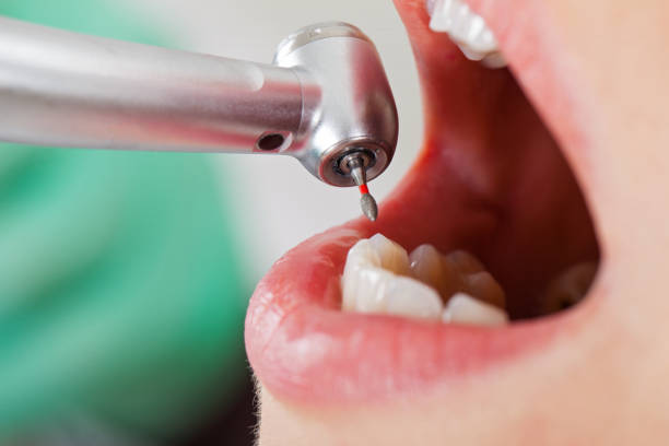 Best Emergency Root Canal Therapy in Harb, OR